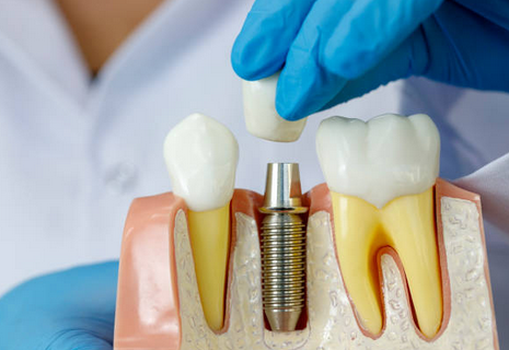 Implant